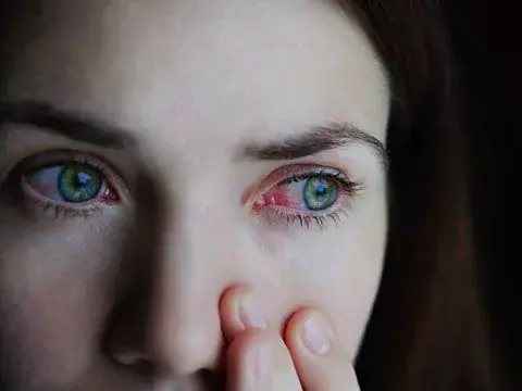 Close-up of a woman with one red, irritated eye