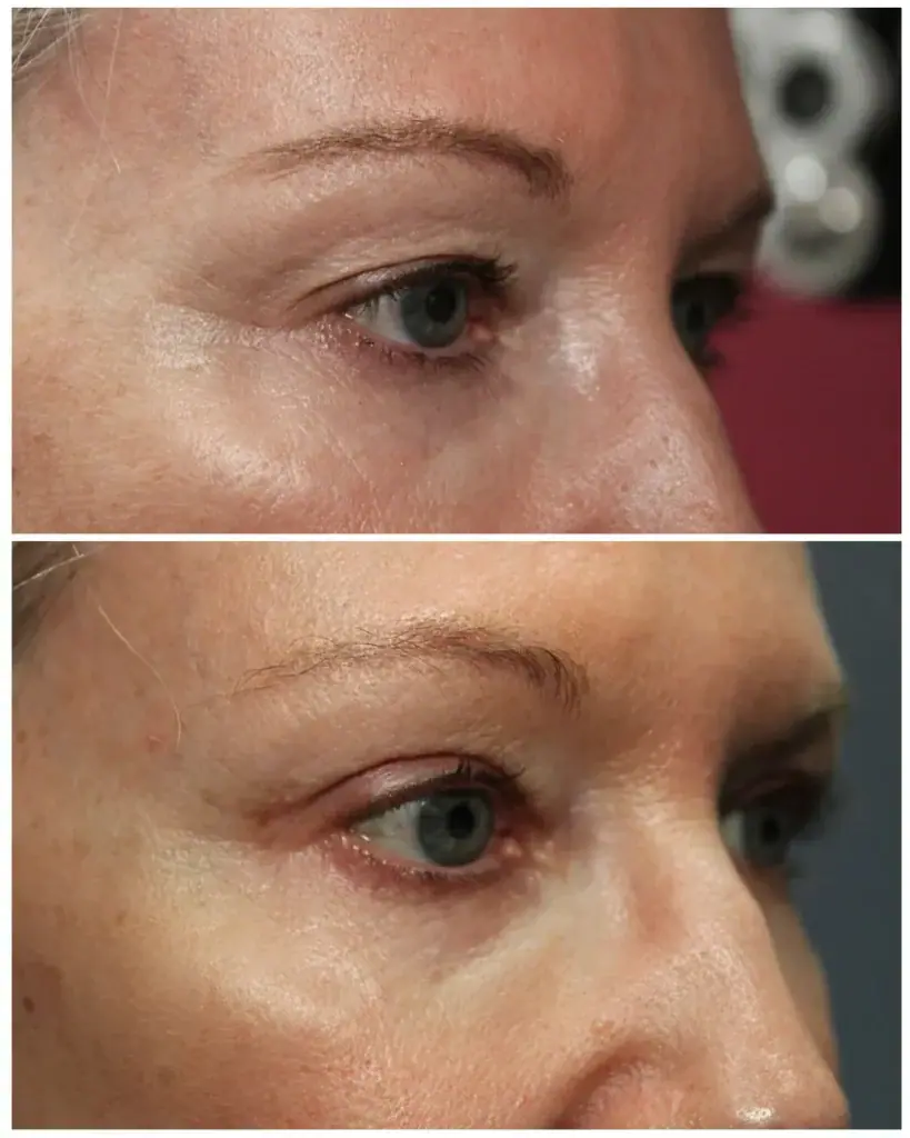 Before and after upper eyelid surgery: heavy upper lids on top, a lifted, rested upper lid below