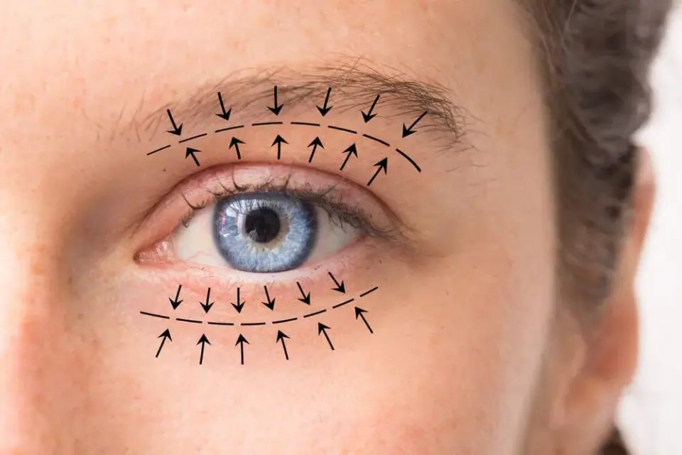 Close-up of a blue eye with arrows drawn on the upper and lower eyelids