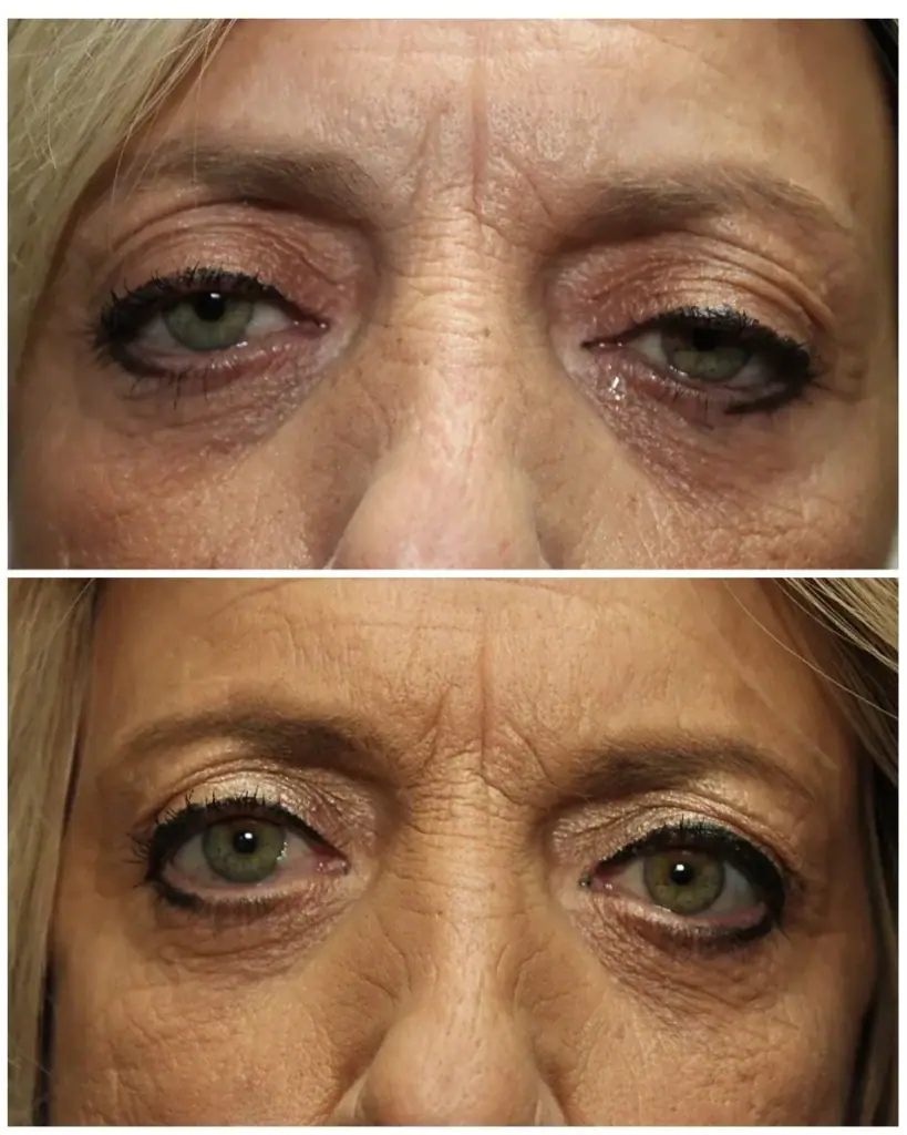 Before and after ptosis repair: drooping upper lids on top, open, even upper lids below