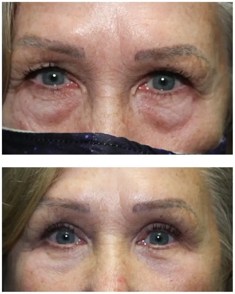 Before and after eyelid surgery: puffy lower lids on top, smoother lower lids below
